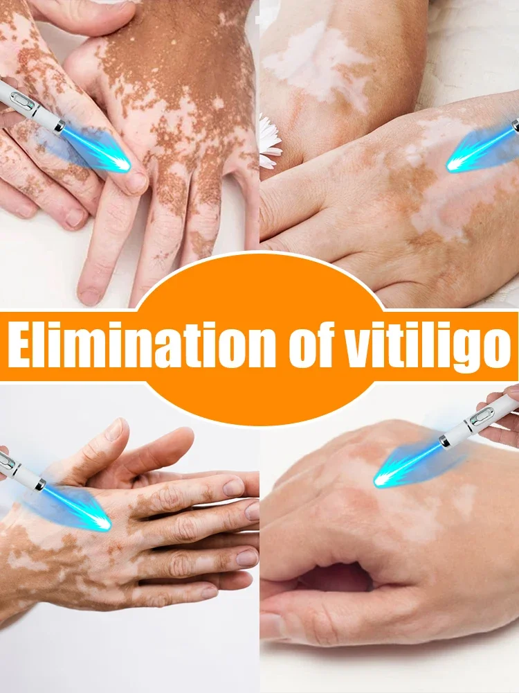 El vitiligo mejora rápidamente las manchas blancas.