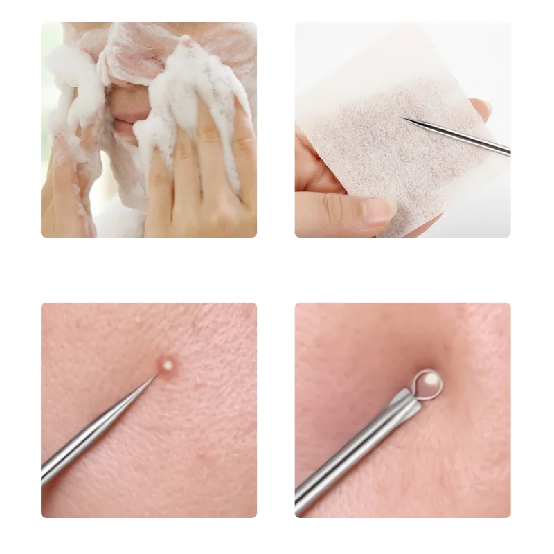 4 ピース/セットにきび除去針ステンレス鋼にきび傷にきび除去スプーン顔スキンケアツール顔毛穴クリーナー