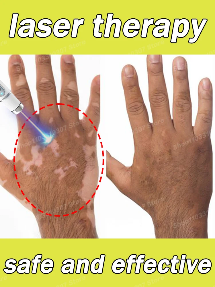 

Vitiligo Ointment White Spot Skin Eliminate Care