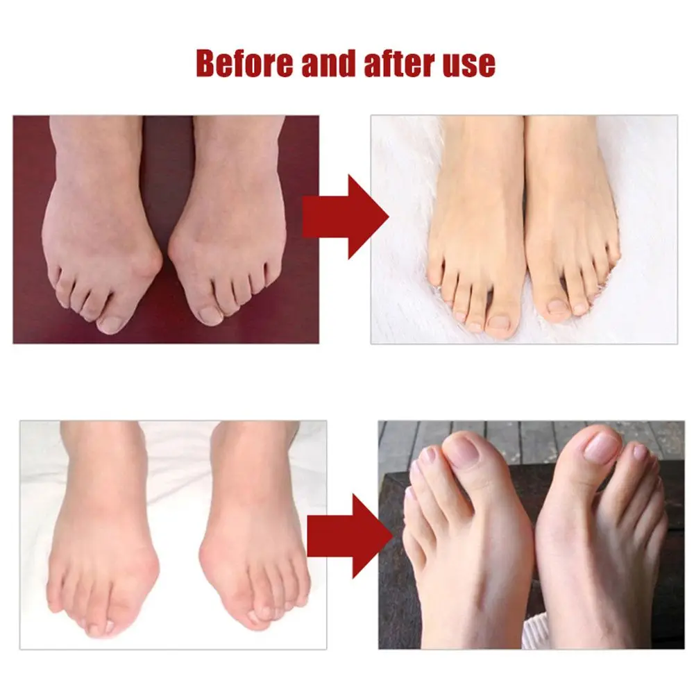 1Pair Bone Ectropion Hallux Valgus Corrector Toes Outer Appliance Foot Care Tools Toes Separator