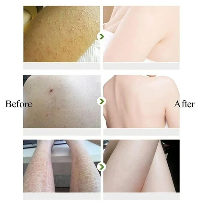 Chicken Skin Removal Treatment Body Cream Repair Keratosis Pilaris Rough Bumpy Pore Spots Dull Skin Care whitening Moisturizing