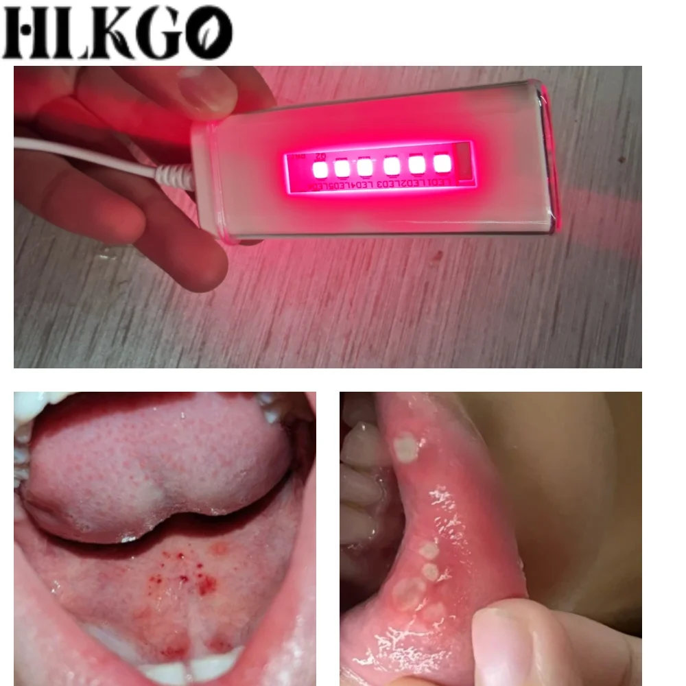 

Portable Oral Red Light Therapy Device - Soothes Mouth Ulcers, Reduces Inflammation, Speeds Up Healing Process