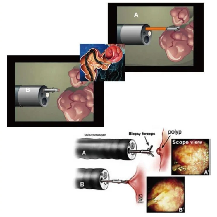 Disposable Endoscope Sampling Forceps