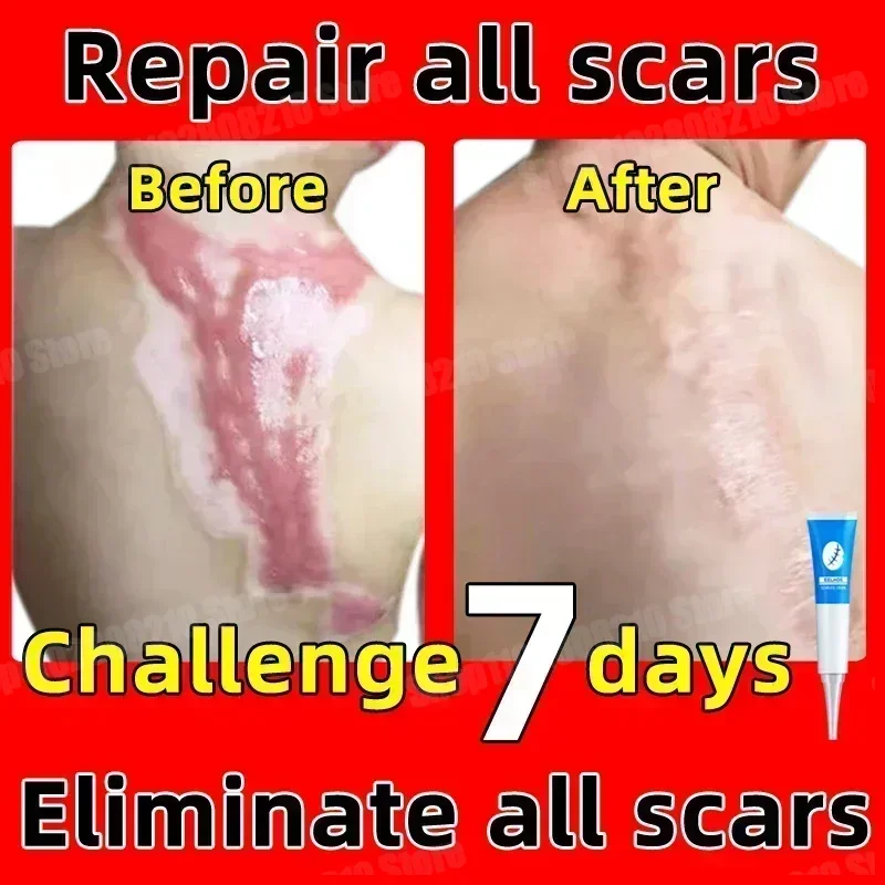 Scar Removal Cream Old Scar Cream Effective Repair New Scars Surgical Scars Stretch Marks Acne Pits Acne Marks Burn Scars