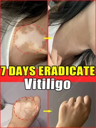 Vitiligo Treatment Cream Melanin Growth Ointment Fast Remove White Spot