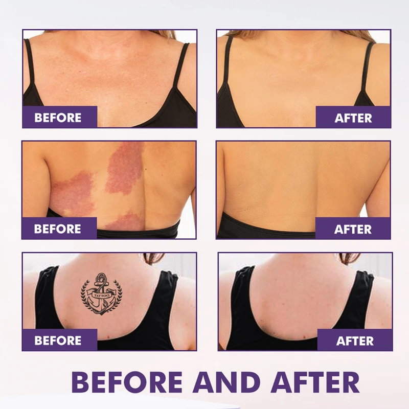 タトゥーコンシーラー傷カバー傷跡あざダークフルカバレッジ防水均一な肌ボディカバレッジパーフェクターメイクアップ