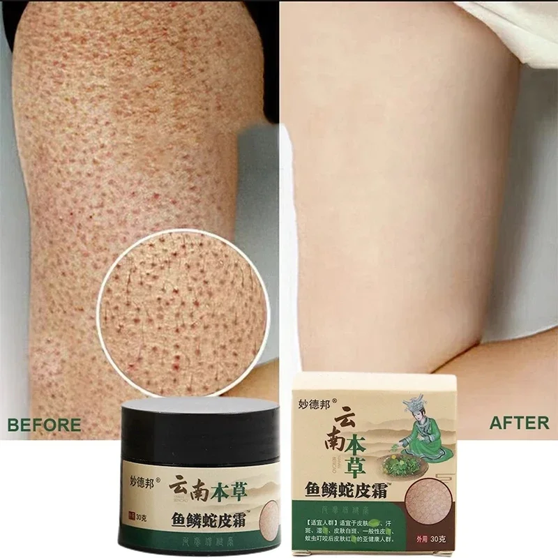 30ml Curing Keratosis Pilaris Repair Cream Chicken Follicle Skin Body Scrub Dark Spots Remove Smooth Moisturize Whitening Creams