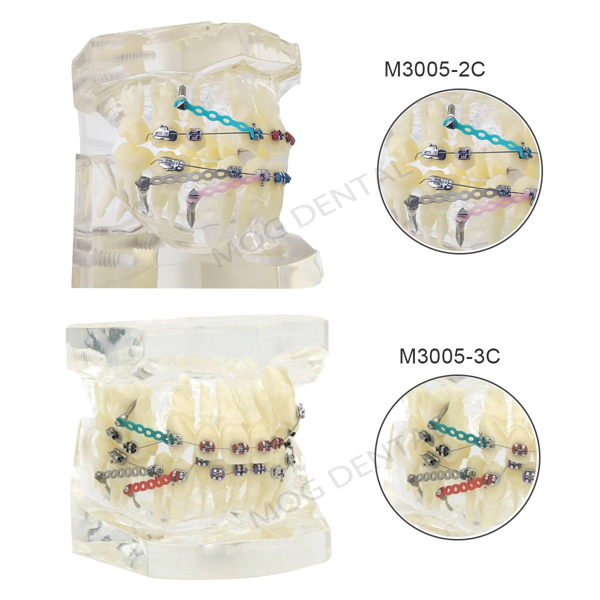 Dental Model with Orthodontic Bracket Dental Teaching Model For Dentist Treatment Demo Training Studying