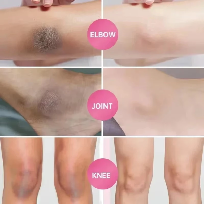 Whitening Cream Private Parts Underarm Bleaching Serum Whiten Butt Knee Brighten Inner Thigh Intimate Parts Dark Remove Melanin