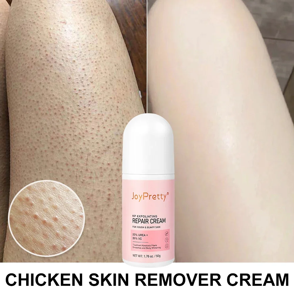 Chicken Skin Care Cream Treatment Keratosis Pilaris Follicle Rough Bumpy Spot Skin Repair Cream Whitening Moisturize Body Lotion