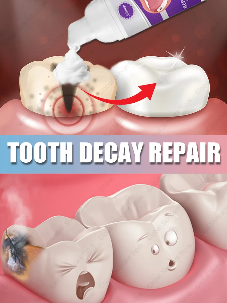 decay Tooth Repair Repairing Cavities Protect Anti caries