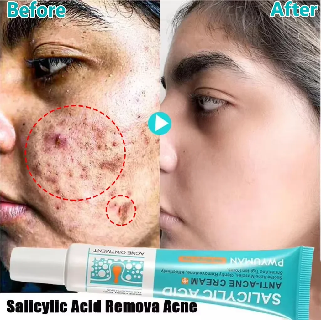 

Salicylic Acid Acne Removal Face Cream Acne Treatment Anti Pimples Spots Gel Repair Scars Pores Shrinking Oil Control Skin Care