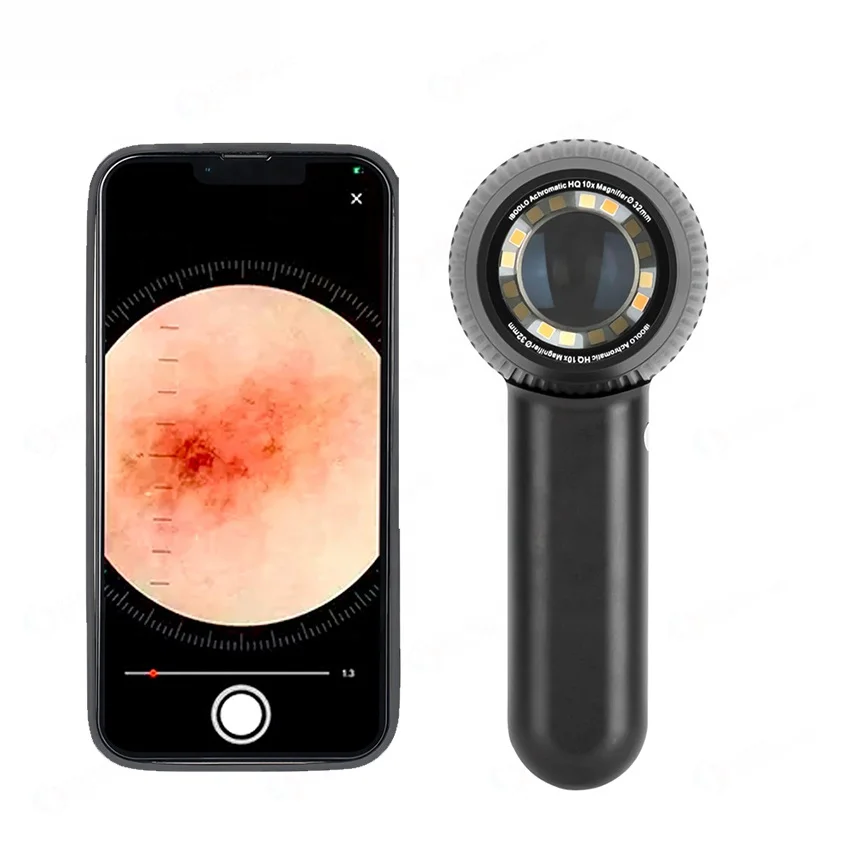 Dermatoscope 10x Magnifying Dermoscopy for  Pigmentation Diagnostic