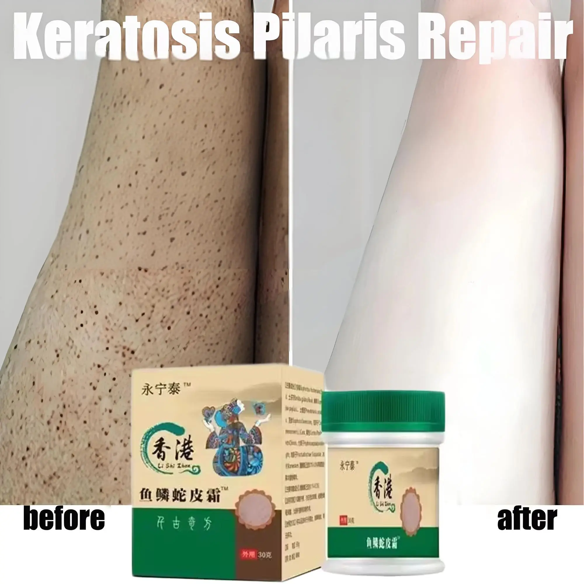 

Chicken Skin Removal Treatment Body Cream Repair Keratosis Pilaris Rough Bumpy Pore Spots Moisturizing Whitening Dull Skin Care