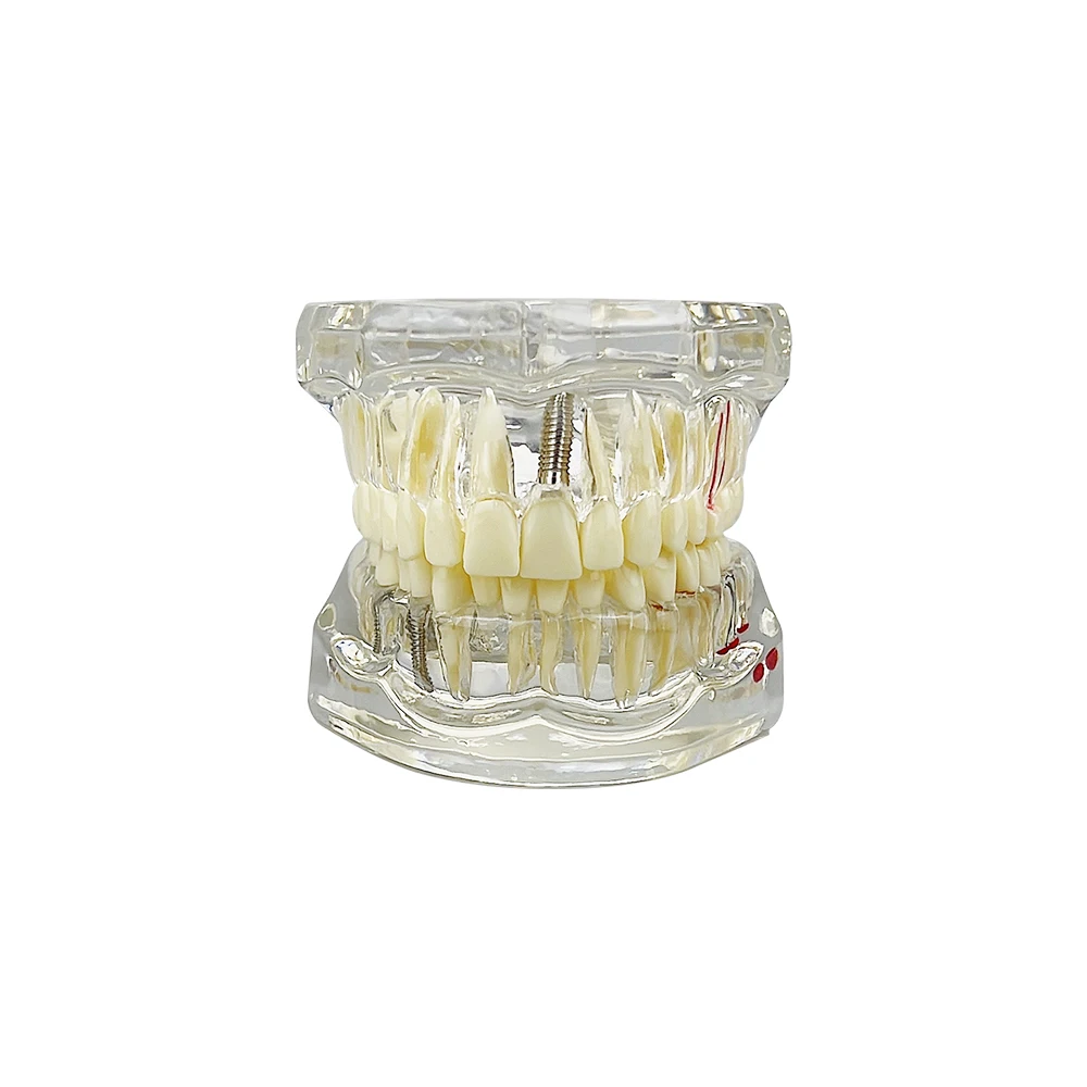Abnehmbares Zahnmodell, Implantatkrankheit, Zahnarzt, Studium, neues Dentalmodell, Zahnimplantat, Wiederherstellung, Brücke, Lehrdemonstration