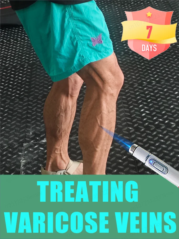 

Remove varicose veins within a week without recurrence