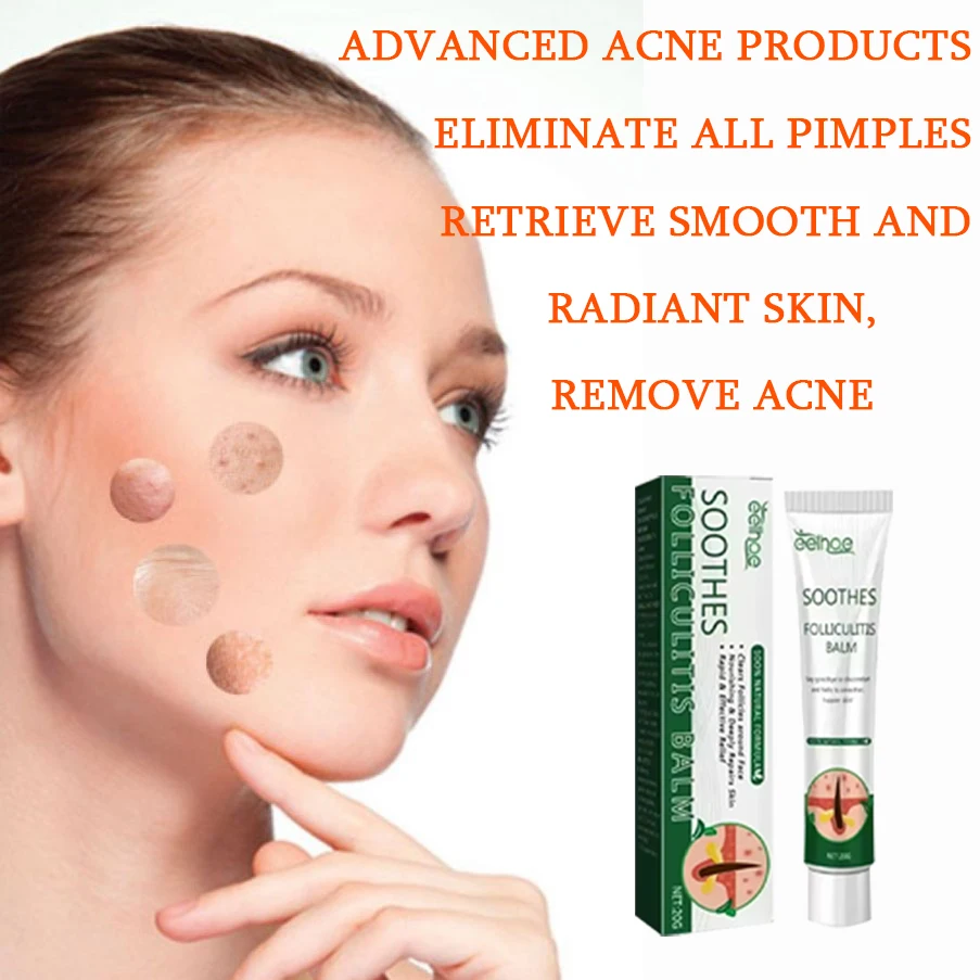 

Acne Removing&Anti acne Cream Treatment of Acne Marked Skin Care Whitening&Acne Removing face cream Smooth&Whitening face cream
