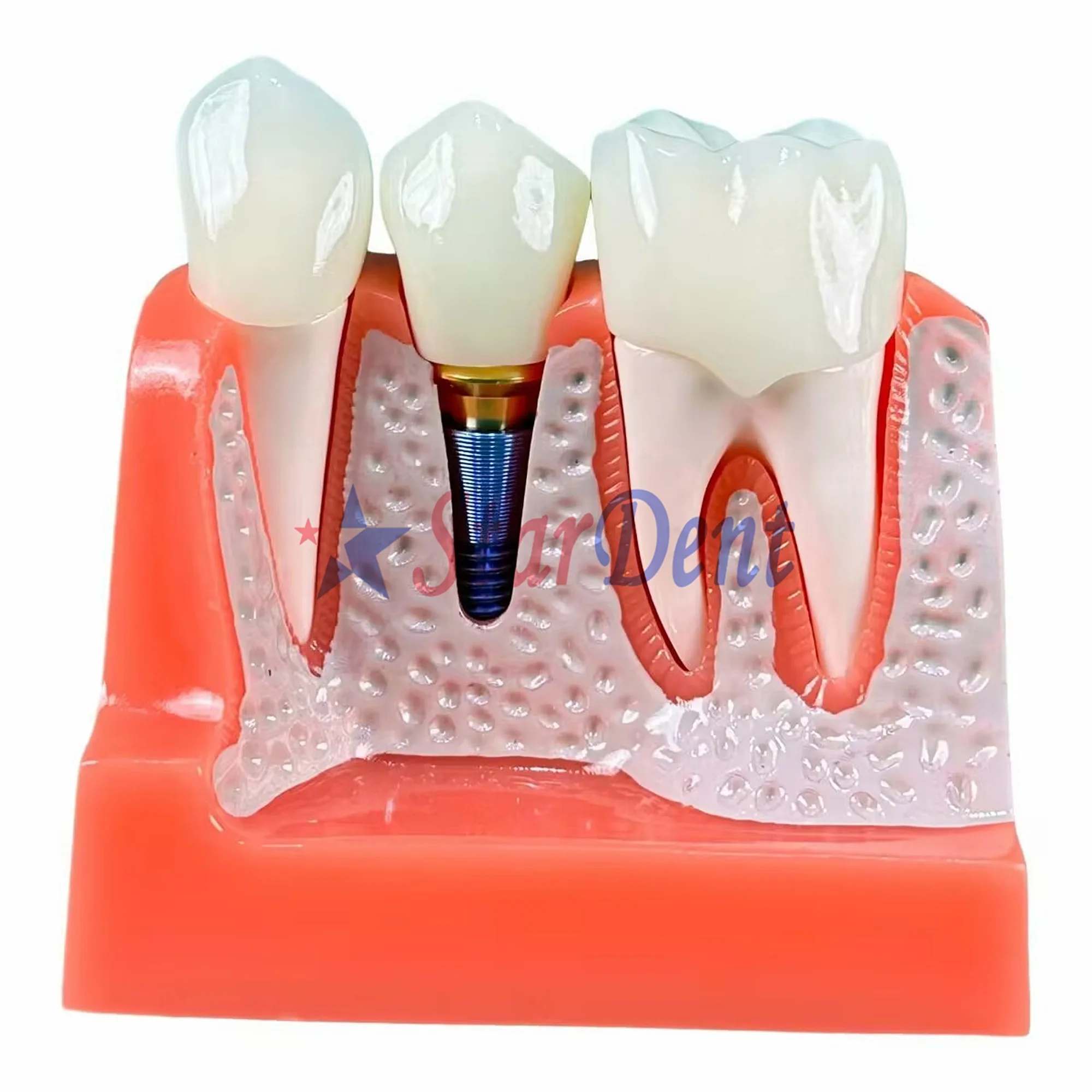 4X Dentals Implants Model Removable Analysis Crown Bridge Demonstration Teeth for Dentals Study