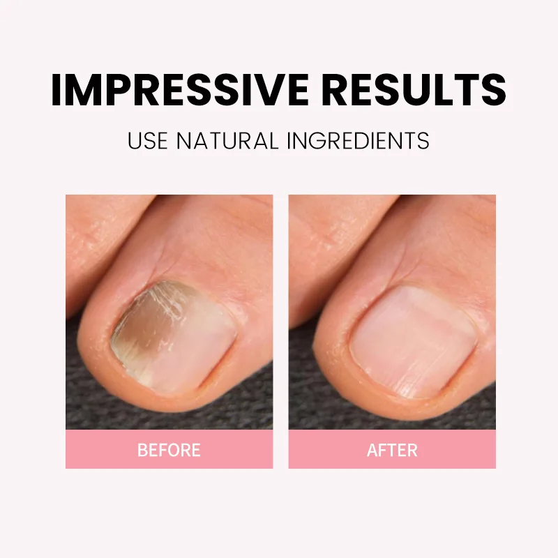 Cuticle Care Roller Ball - Intensive Moisturizing Treatment to Strengthen Nails & Prevent Peeling Skin