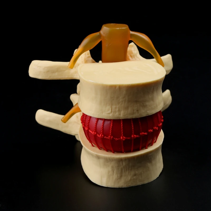 Modelo de enseñanza de hernia Lumbar, Anatomía Humana, esqueleto, columna vertebral, vértebra, modelo de demostración de Patología