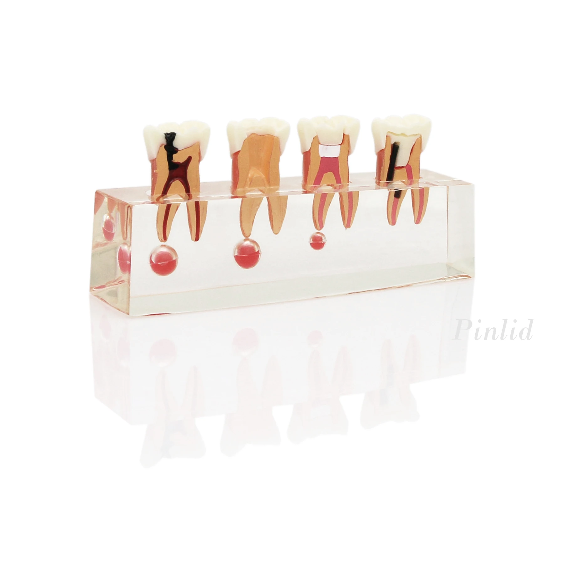 Dental Treatment Model 4-Stage Endodontic  for Study Teaching Teeth Model 4018 Root Canal Demonstration Teach Tooth Model Clear