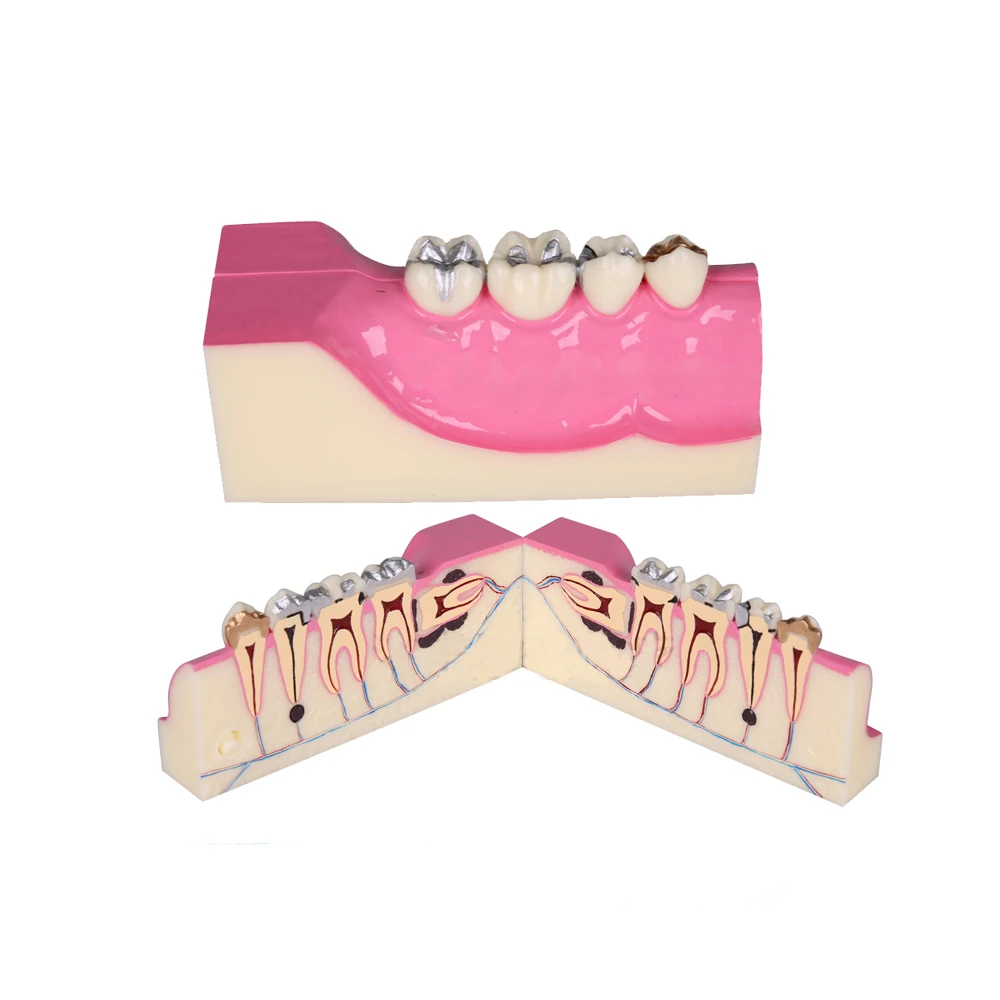 

Dental Model Molar Cross Study And Teaching Demonstration Right Lower Tooth Tissue Decomposition Model M4009