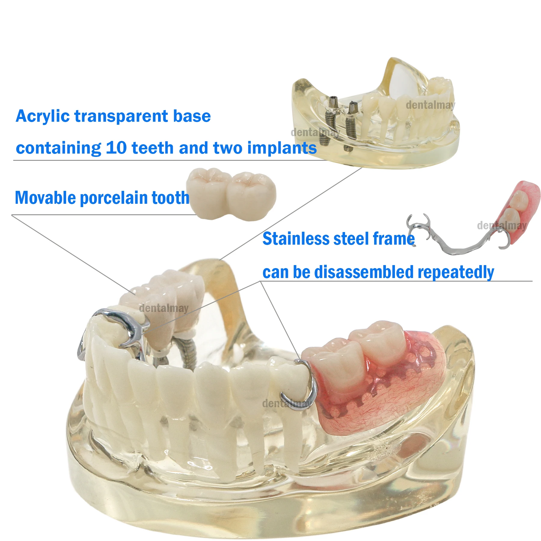 Dental Implant Restoration Typodont Teeth Model with Partial Denture M6022