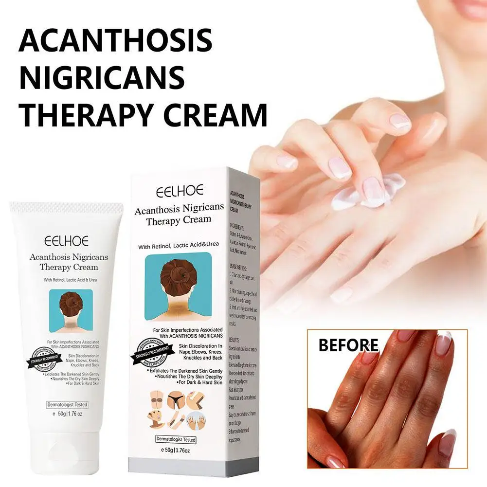 

Acanthosis Nigricans Therapy Cream Removal Neck Ankle 50ml Parts Whitening Body Dark Hyperpigmentation Cream