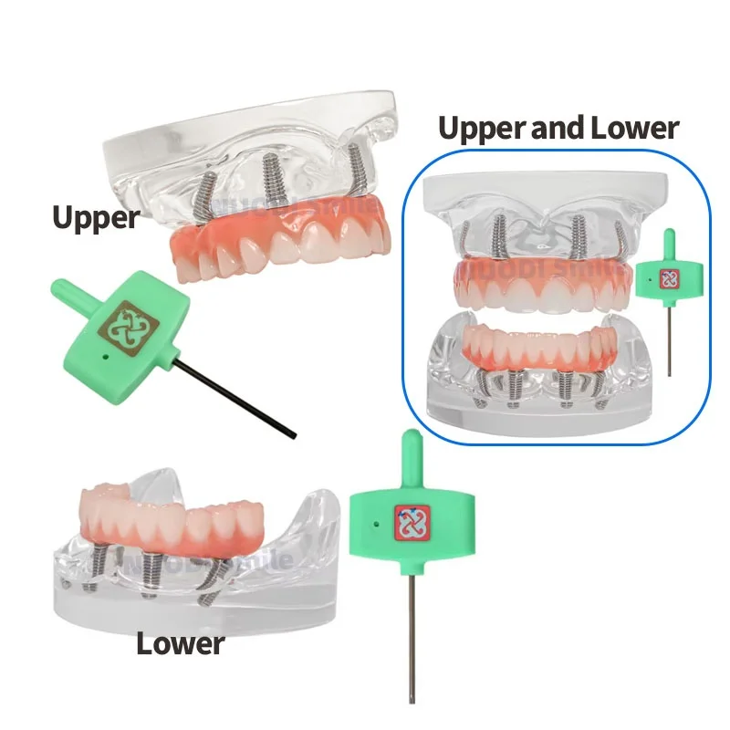 

Dental Implant Upper/Lower Jaw Restoration Teeth Model All on 4 Overdenture Model With 4 Removable Screws for Teaching Studying