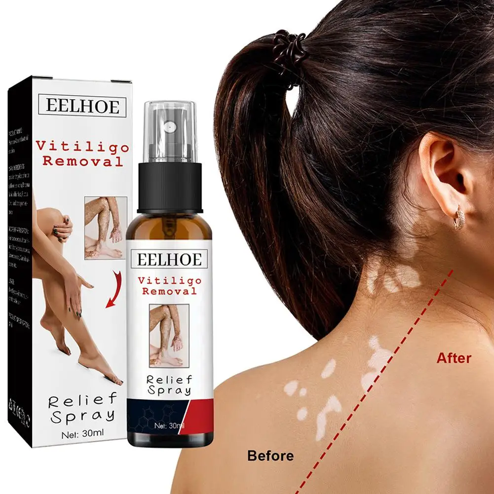 30ml Relief Spray Skin Moisturizing Vitiligo Net Spray Skin Repair Body Face Fades Vitiligo Spot White Spots Repair