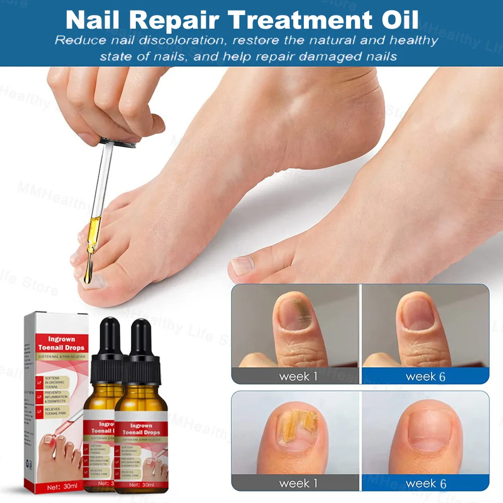 Fungal Nail Laser Device Fast Repair Essence Oil Repair Toenail Fingernail Treatment Onychomycosis with Mushrooms Foot Care