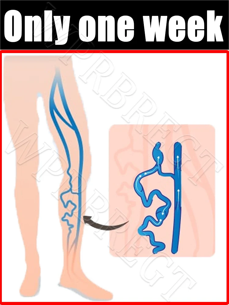 

7-дневный вариант восстановления проблем с венами