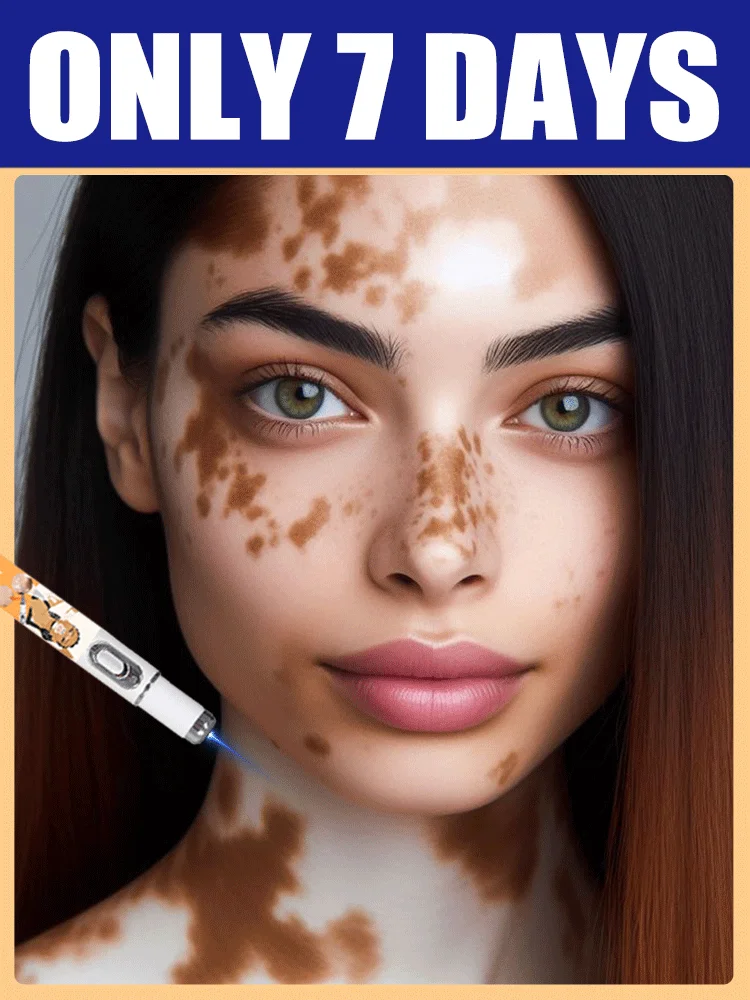 

Модернизированное 3-е поколение Vitiligoвосстановление корня Vitiligo uickly