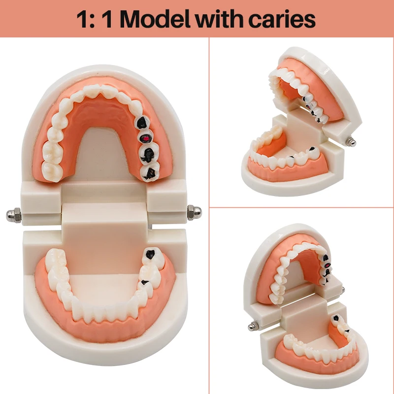 

1 шт., моделирование детской кариес, модель стоматологических кариеса для обучения стоматологии, модель пародонтальной болезни