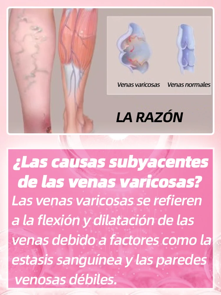 Láser para venas varicosas