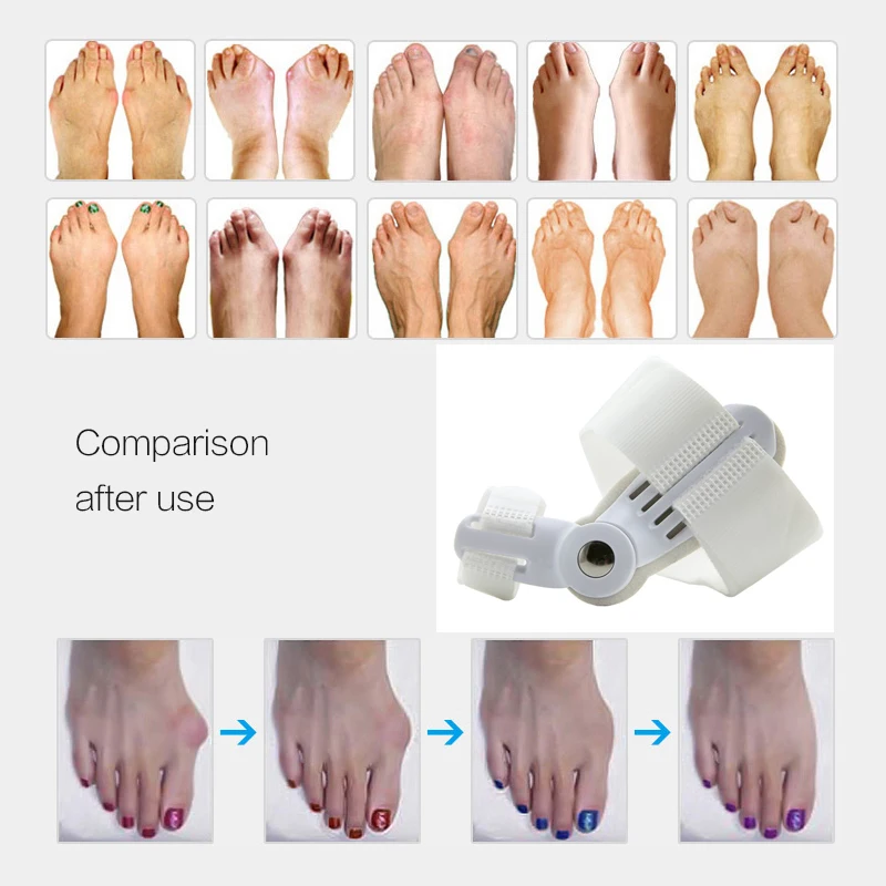 Big Toe Orthotics Bunion Splint Straightener Corrector Foot Pain Relief Hallux Valgus Correction For Pedicure Device Foot Care