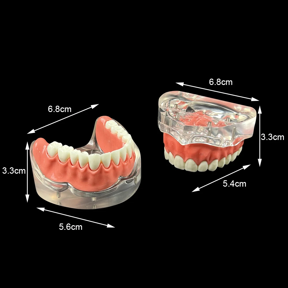 

Transparent Dental Implant Teeth Model with 4 Implants Upper Lower Jaw Overdenture Restoration Typodont For Education Teaching