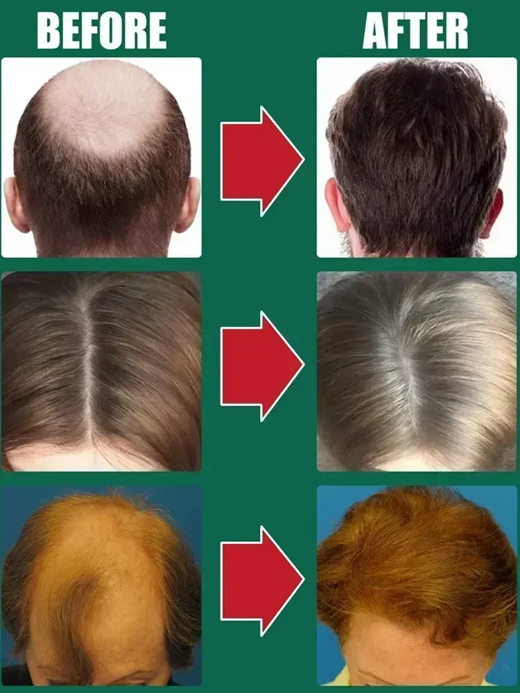 Nutre y cuida el cabello para hombres y mujeres, tratamiento de reparación de cabello con crecimiento, adelgazamiento de cabello seborreico, tratamiento de Alopecia