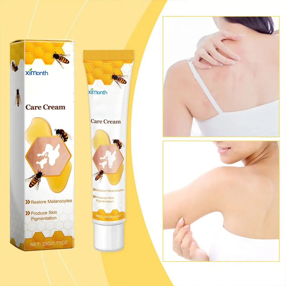 Vitiligo Tratamento Bee Cream, spray de alívio, tratamento da pele lâmpada, mancha branca remoção pomada, eliminar vitiligo