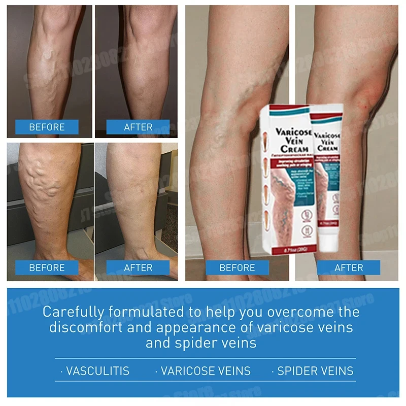 

Varicose Vein Cream Spider Vein Pain 2024