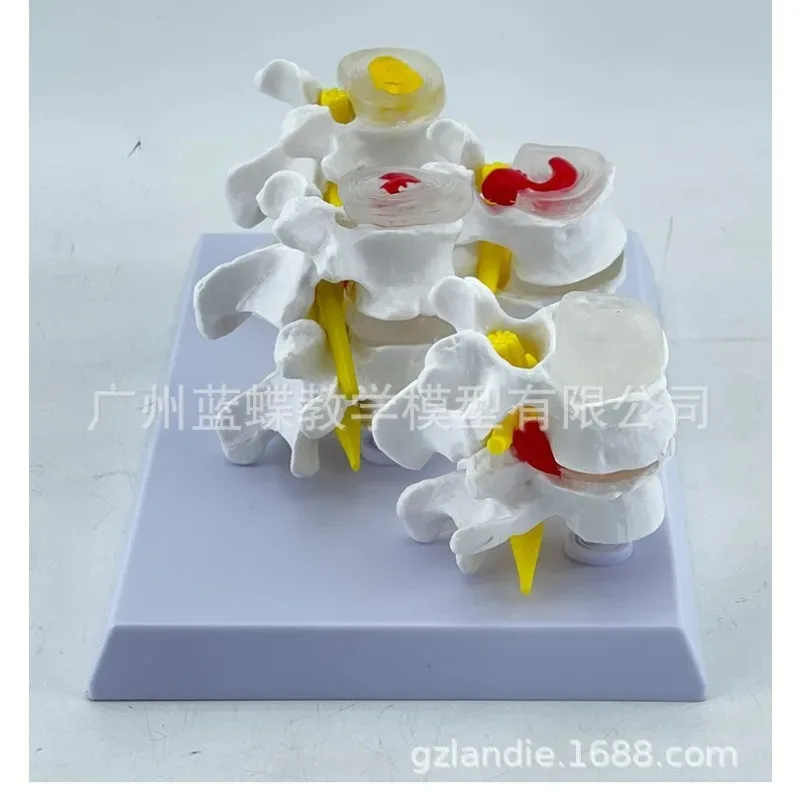 1:1 Life Sized Human Lumbar Spine Normal Lesion Combination Anatomy Medical Model Intervertebral Disc Pain Teaching Bone