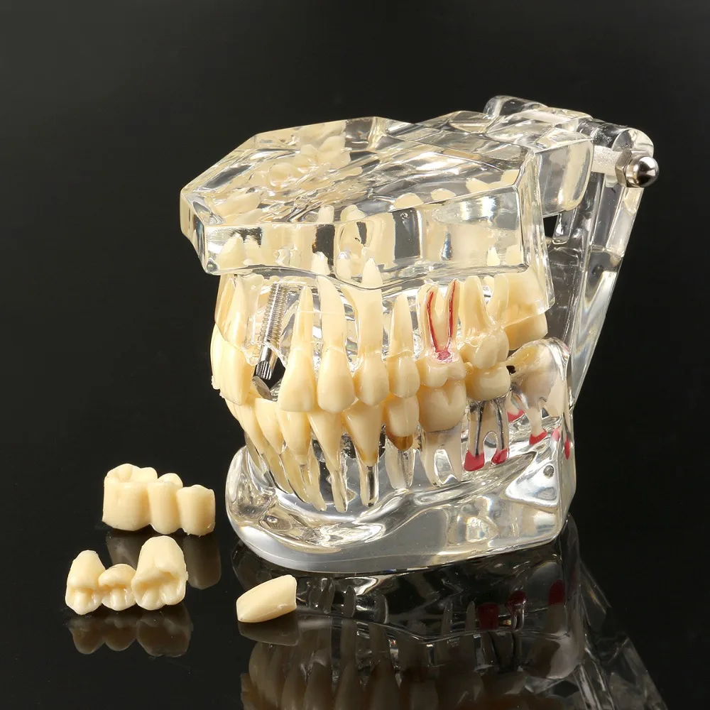 3Pcs Dental Implant Teeth Study Model Repairable Resin Model Of Diseased Teeth For Teach And Research In Medicine Dental Disease