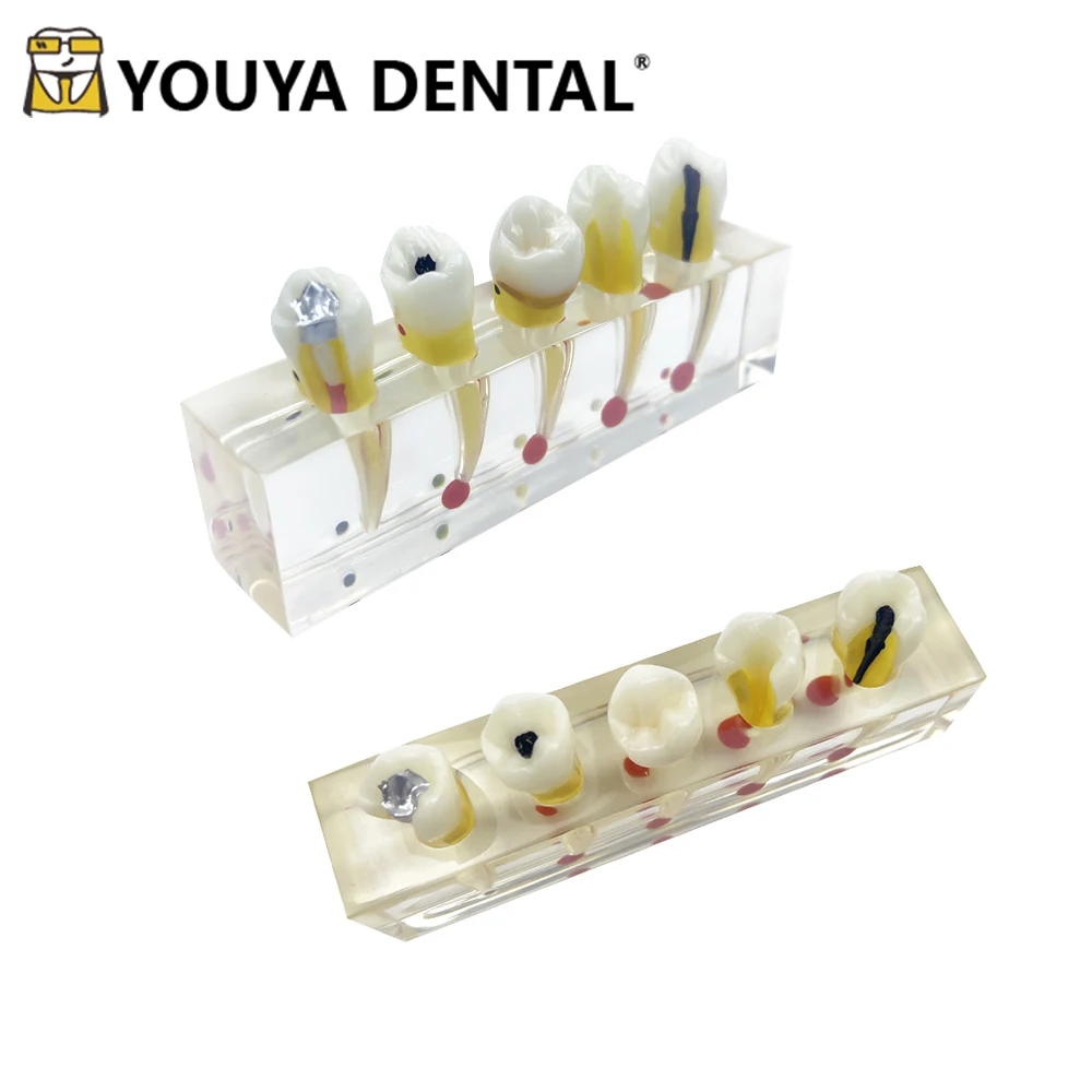 

Dental Pulp Clinical Model Disease Teeth Model for Dentist Student Practice Training Studying Doctor-patient Communication Tools