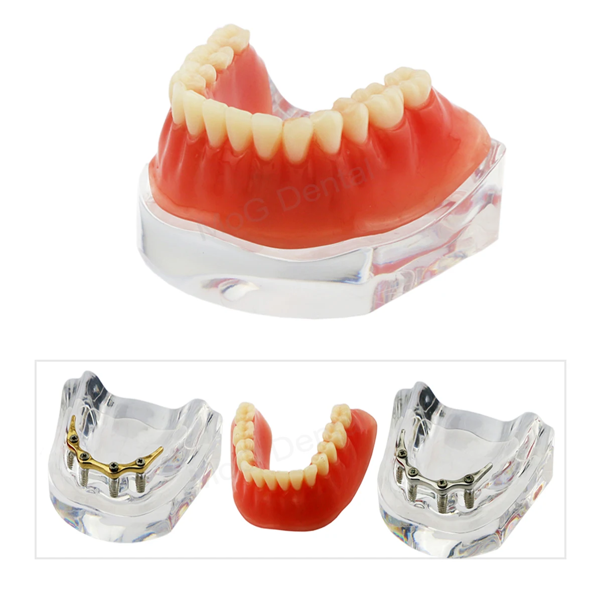 Dental Implant Models with Golden Bar/Silver Bar Overdenture Mandibular Dental Education Model for Dentistry Restoration Demo