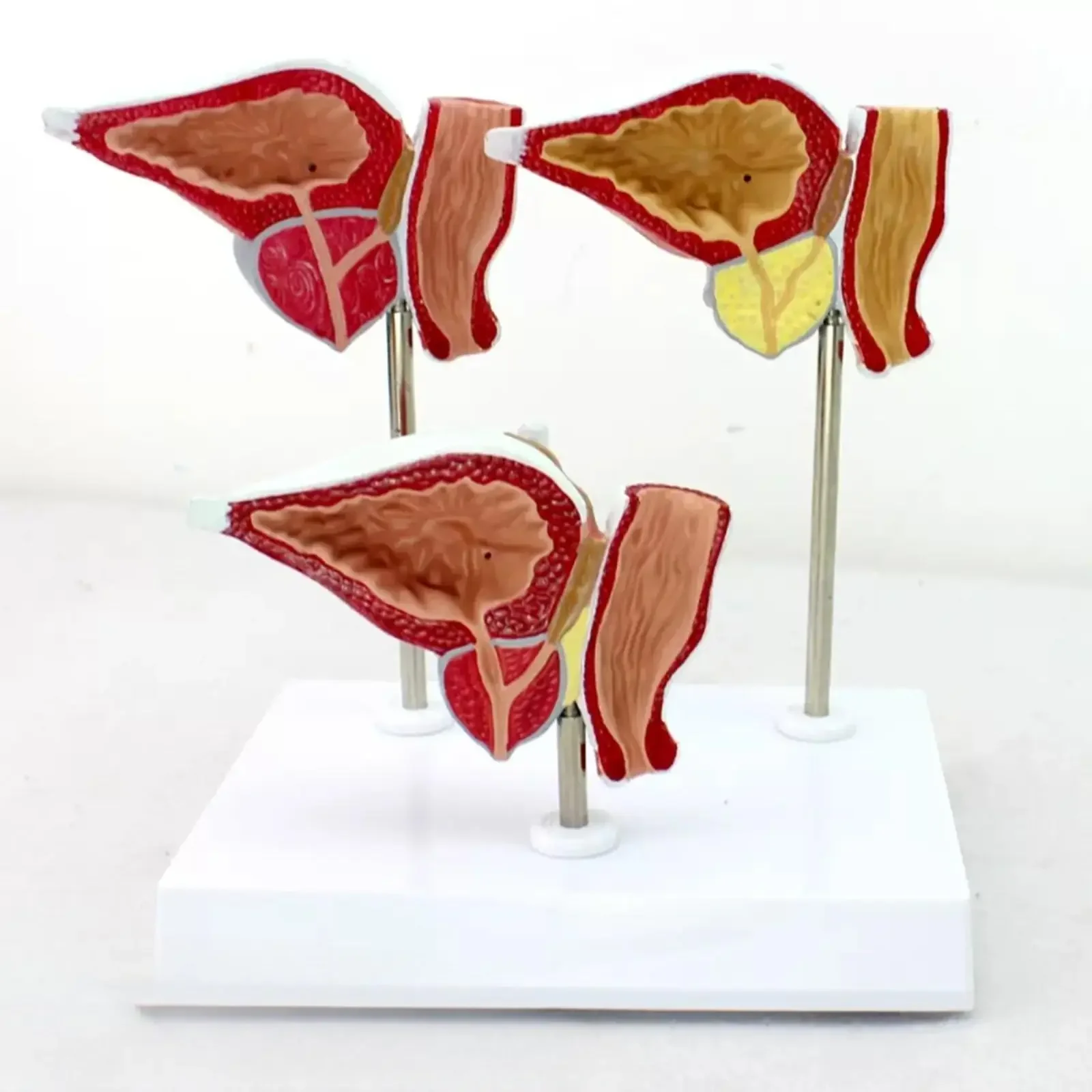PVC Human Prostate Normal Hyperplasia Carcinoma Model Medical Teaching Models