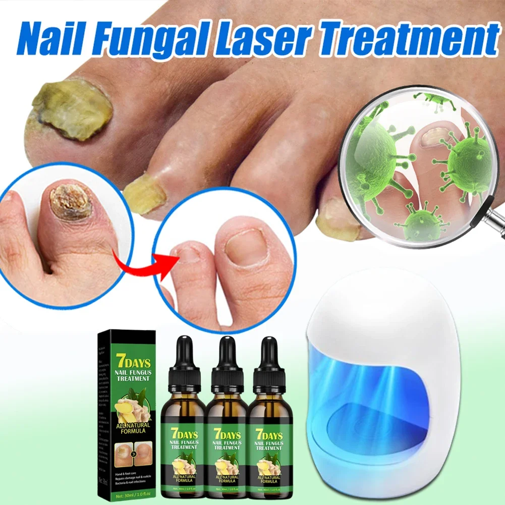 Dispositivo de tratamento do fungo do prego, Unhas do pé, Soro de reparação fúngica, Anti infecção, Unhas cinzentas, Onicomicose, Paroníquia Remover Ferramentas