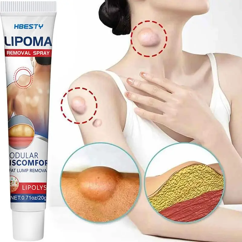 Lipoma Removal Cream Relief Swelling Fat Elimination Cream 20g Remove Subcutaneous Lump Herbal Extract Care Fat Bulges Lump