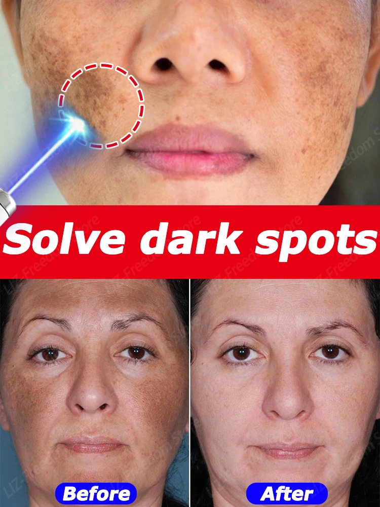 

Highly effective freckle repair facial dark spot