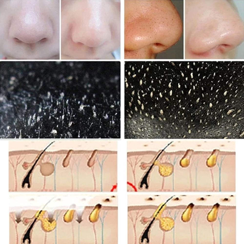 Masque dissolvant de points noirs pour le nez, nettoyage en profondeur, rétrécissement des pores, traitement de l'acné, autocollants de soins pour la peau, 10 pièces