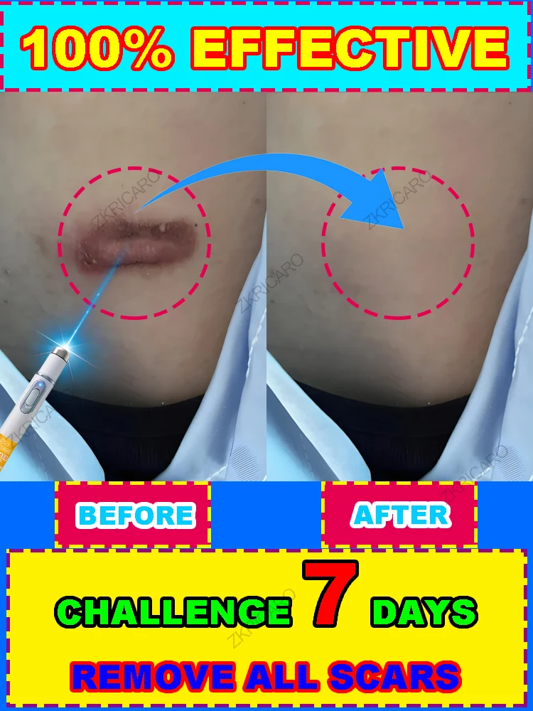 

New laser repair pen, restore natural skin